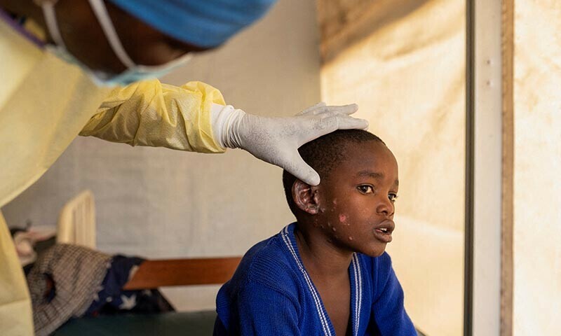 Mpox kills 548 in DR Congo this year - World